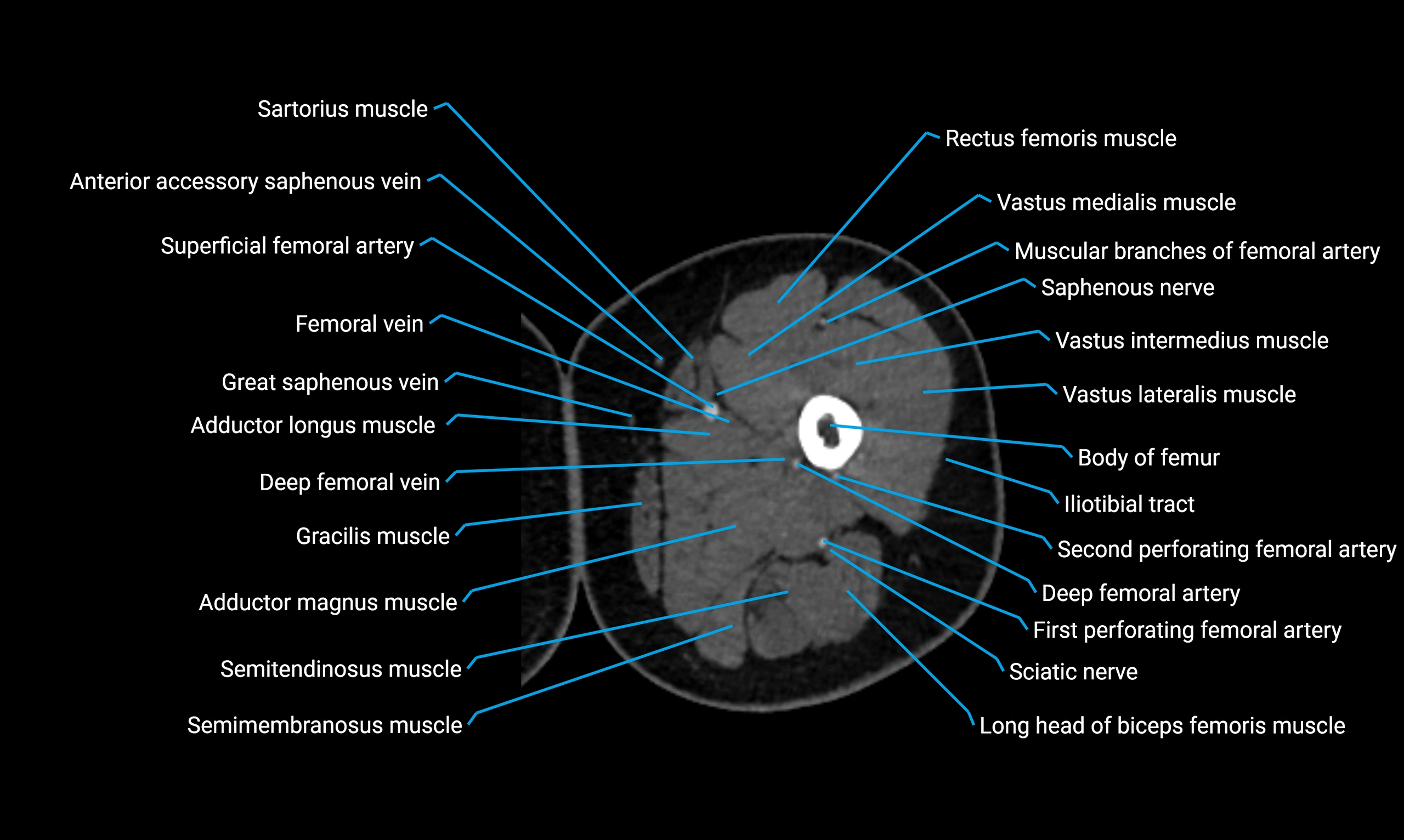 CT lower limb axial cross sectional anatomy labelled image 42 (2).webp